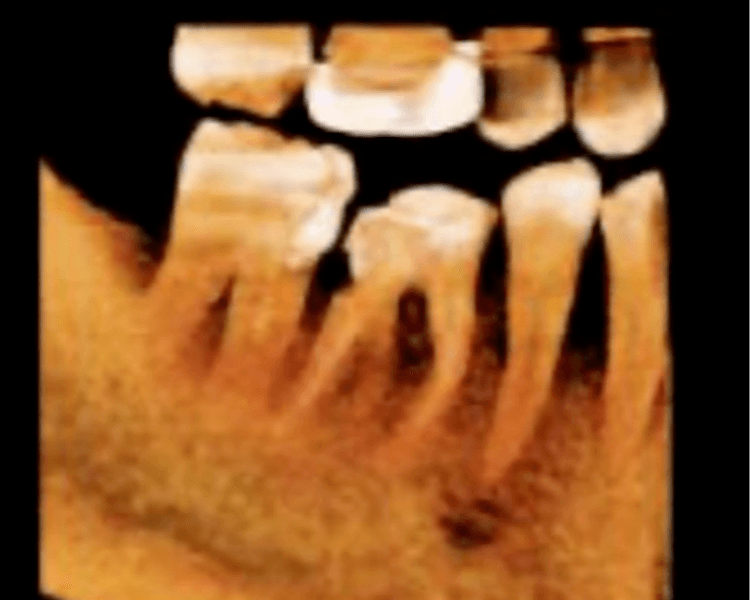 TOMOGRAFIA ENDODONCIA (FOV 4X4 / 5X5 )