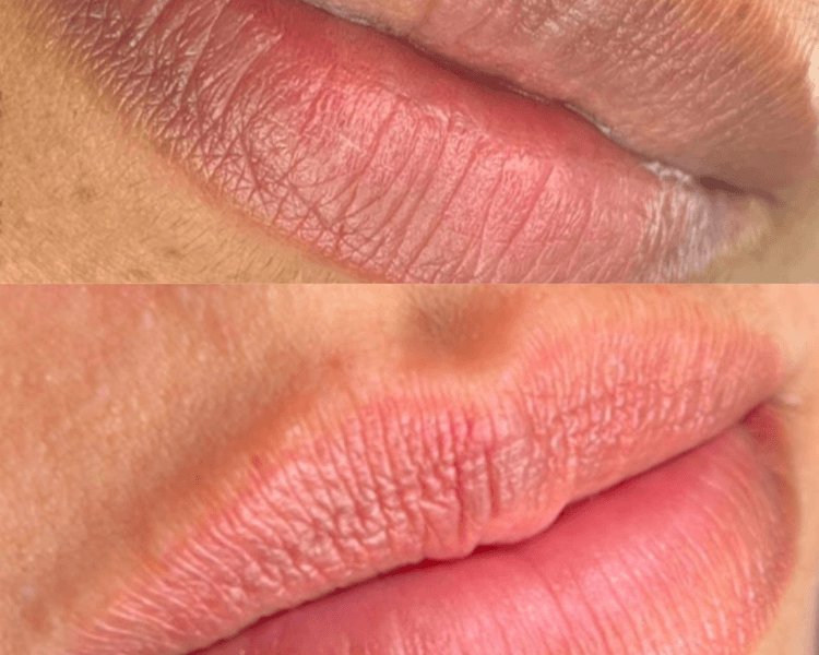 Neutralización de labios (oscuros y manchados)