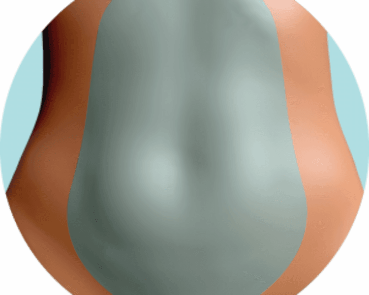 Láser en pubis 6 sesiones