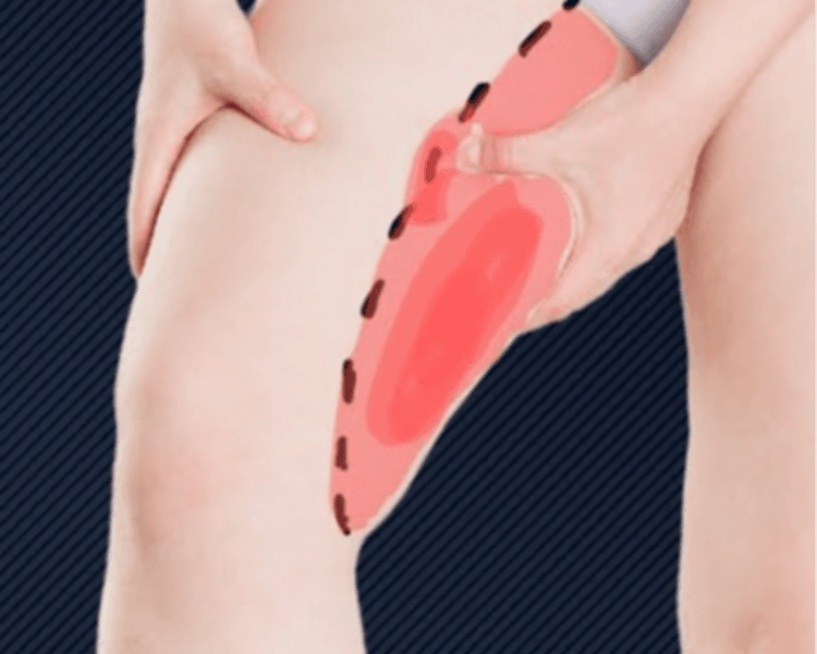 Láser en entrepierna 10 sesiones