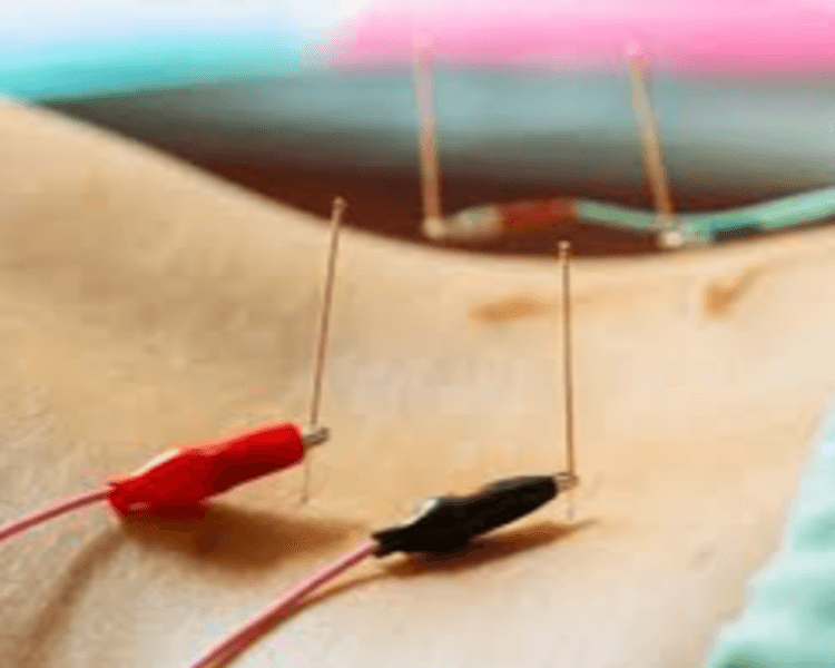 Electroacupuntura