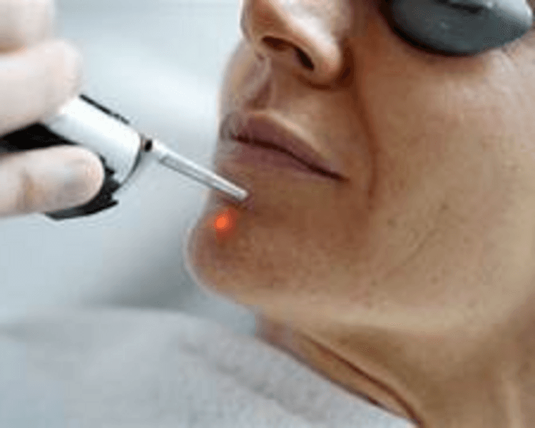 Láser despigmentante