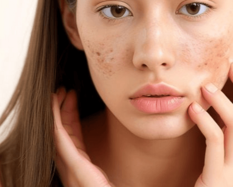 TRATAMIENTO PARA ACNE