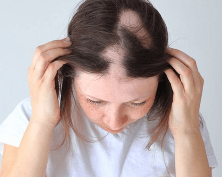 HAIR LOSS CONTROL