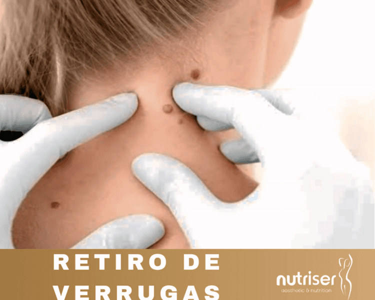 Retiro de Verrugas