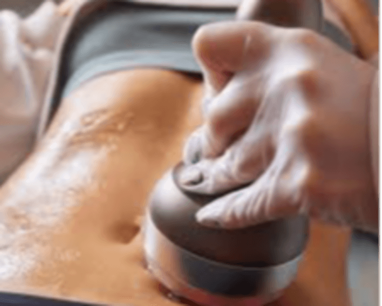 RADIOFRECUENCIA MULTIPOLAR CORPORAL