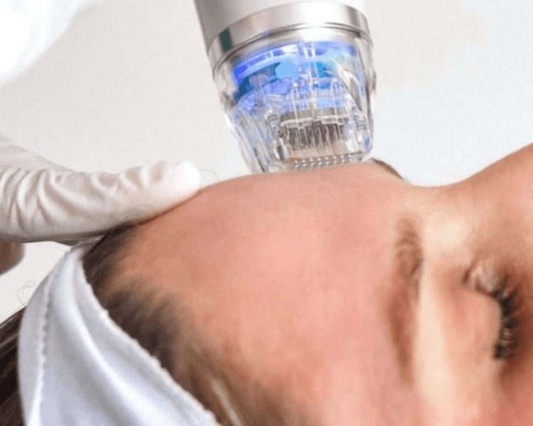 RADIOFRECUENCIA FRACCIONADA CON MICROAGUJAS