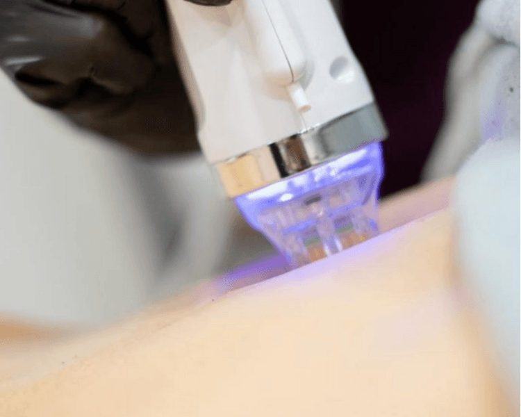 RADIOFRECUENCIA FRACCIONADA CON MICROAGUJAS