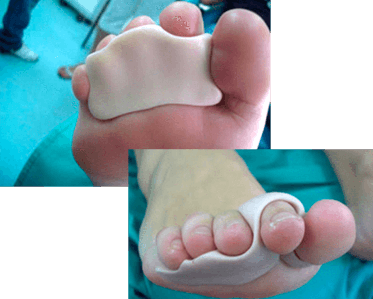 Ortesis de silicona 4gr