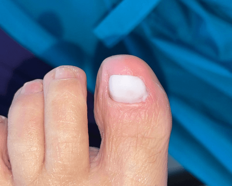 Reconstrucción ungueal 1 uña