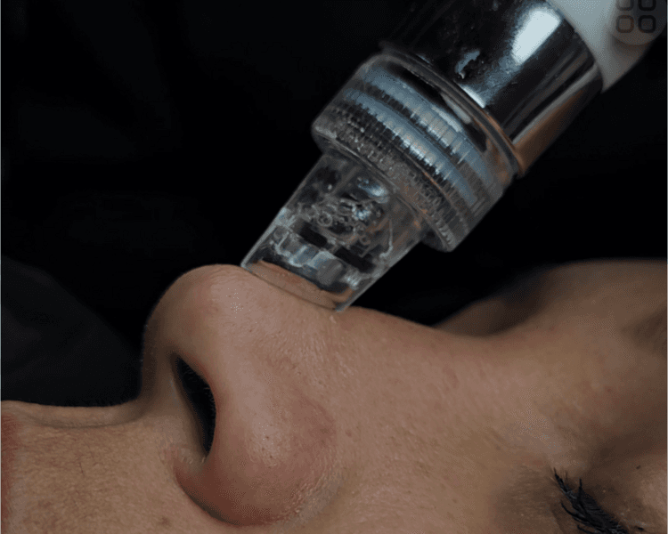Limpieza Facial Pro (Hydrafacial)
