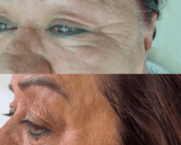 Plasma rico en plaquetas paquete