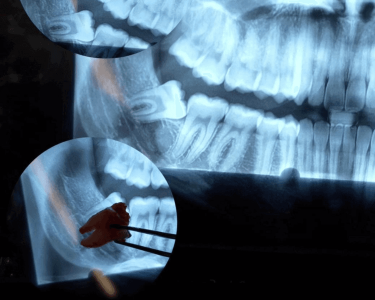 CIRUGÍA DE TERCERA MOLAR