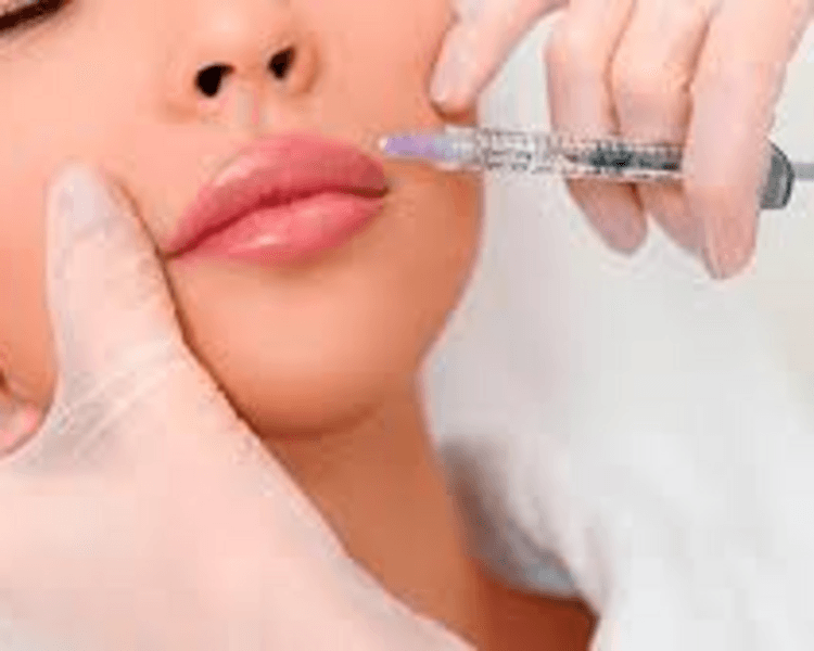 Relleno de Labios (1 ml)