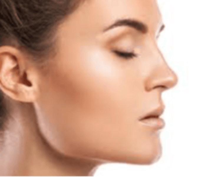 Marcaje mandibular con acido hialuronico (2 ml)