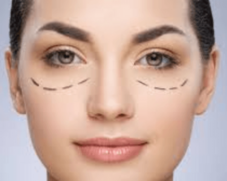 Relleno de ojeras (1ml)