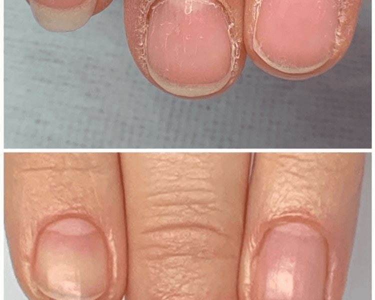 Remoción de cutículas