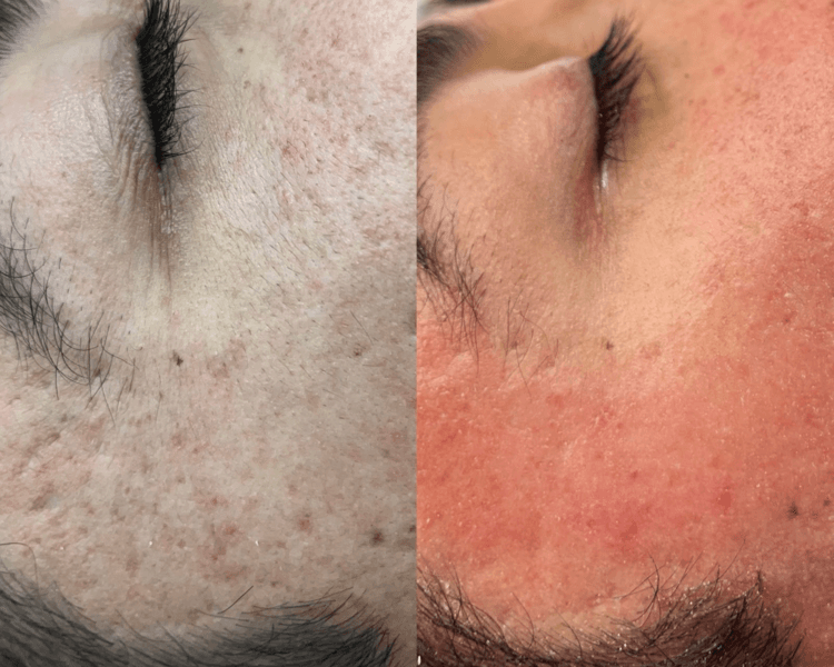 Microneedling facial