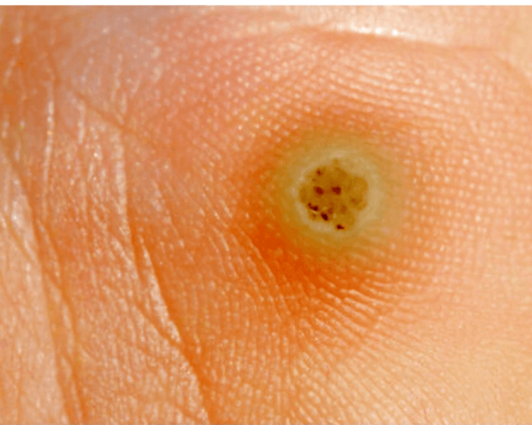 Eliminación de Verrugas Plantares (Según Valoración)