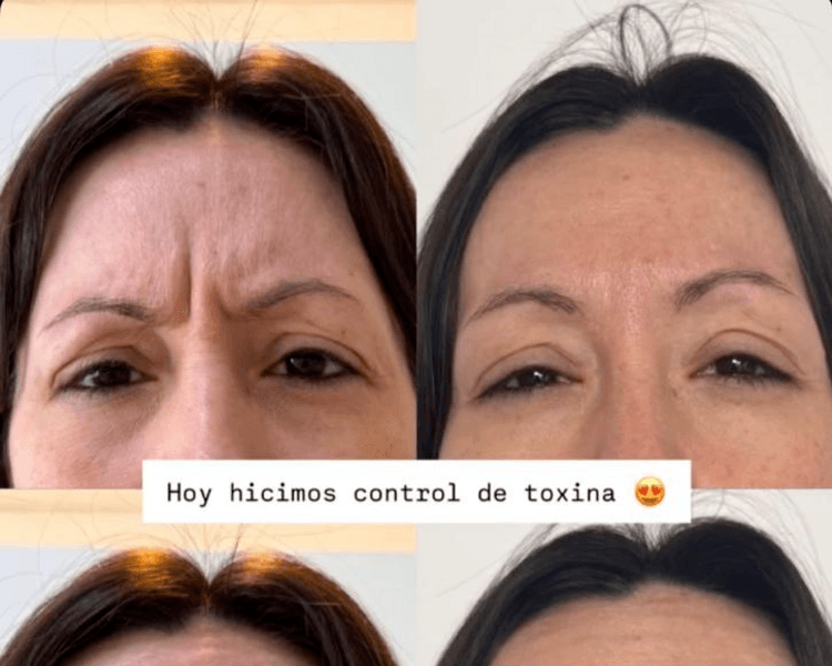 Toxina Botulinica (botox) tercio superior