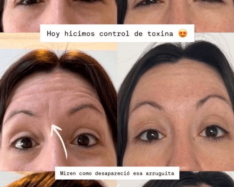 Baby botox (Entre cejo)