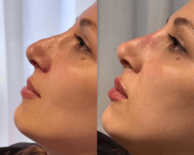 Rinomodelación con acido hialuronico