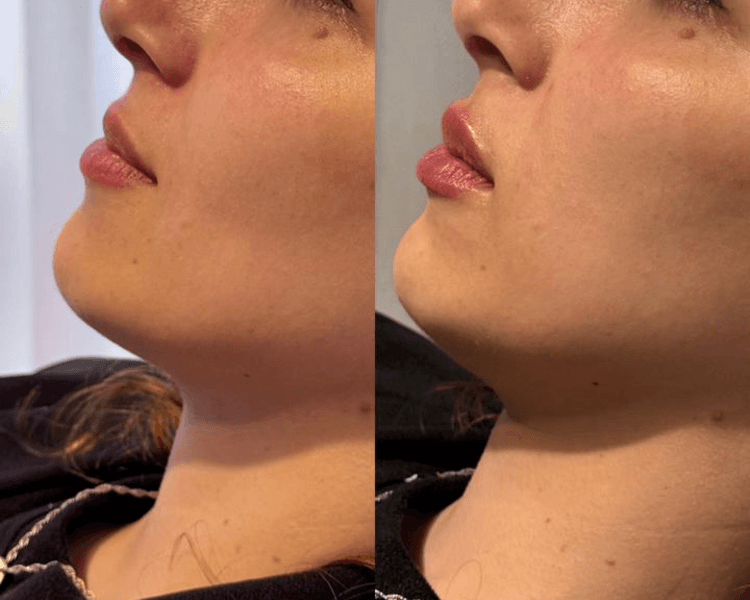 Diseño de Labios con acido hialuronico