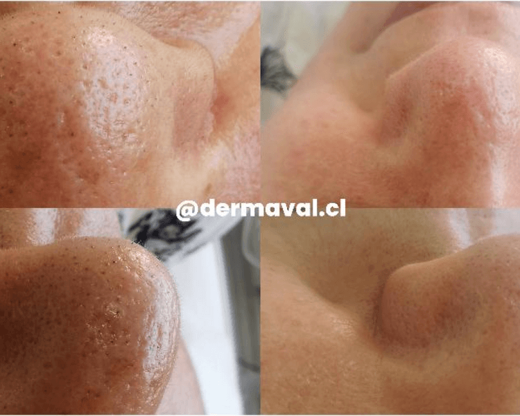 Limpieza facial