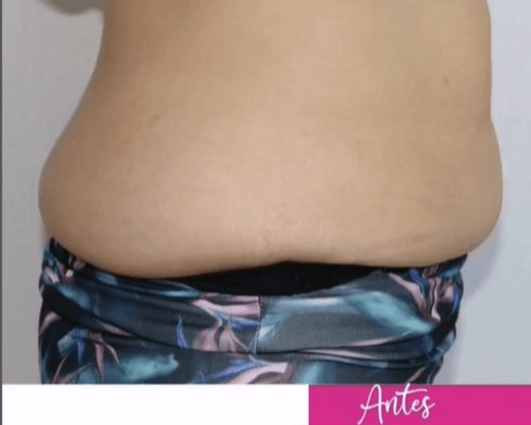 Lipolisis con Lipolax - 1 zona - 1 sesión