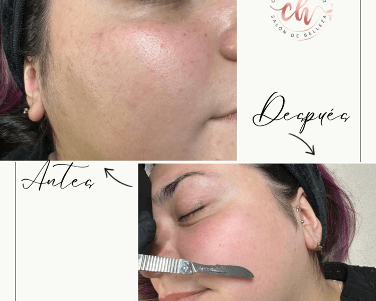 Dermaplaning o Mesoexfoliacion