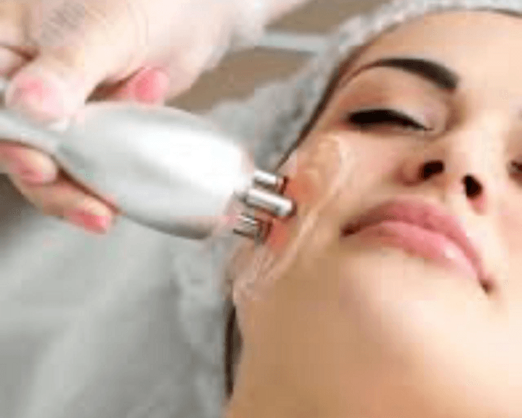Radiofrecuencia facial ( 4 sesiones)