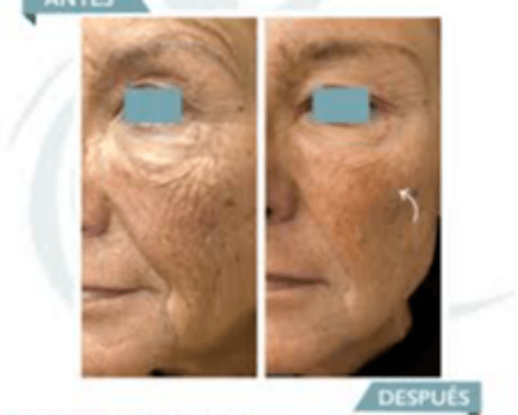 Radiesse ®: (Bioestimulador y relleno con hidroxiapatita de calcio)