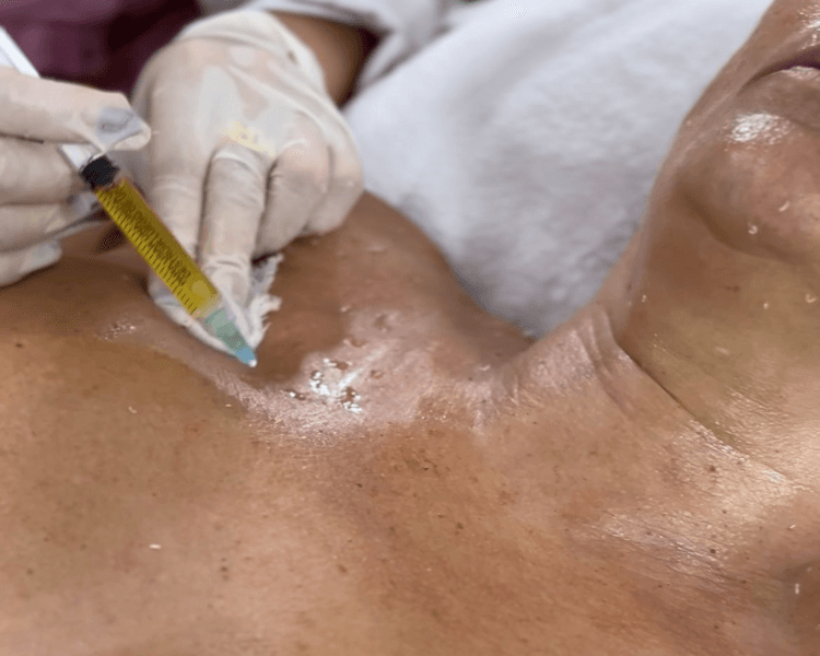 Mesoterapia corporal: Reductora / Flacidez / Drenante