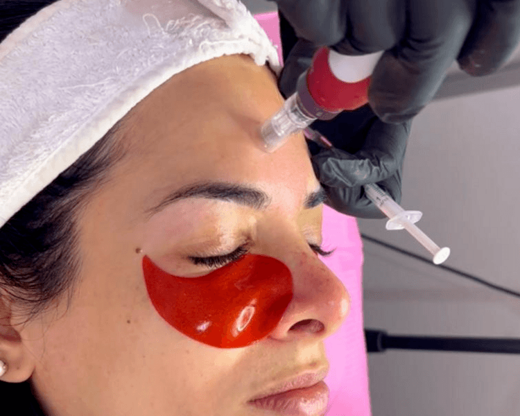 Limpieza profunda + Microneedling (Dermapen)