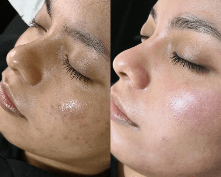 Limpieza profunda + Microneedling (Dermapen) + Peeling Químico