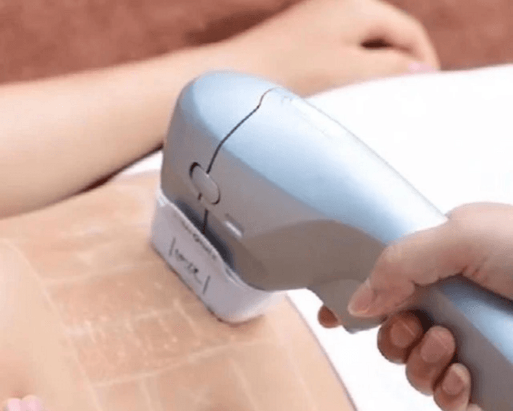 HIFU Abdomen ( 3 sesiones)