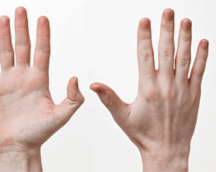 HIFU Manos (2 sesiones)