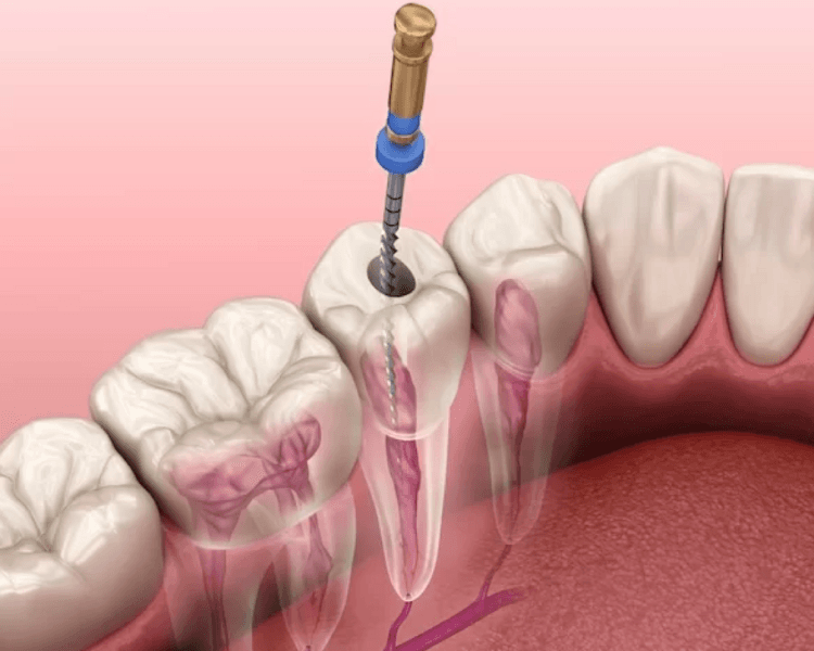 Tratamiento de conducto (anteriores)