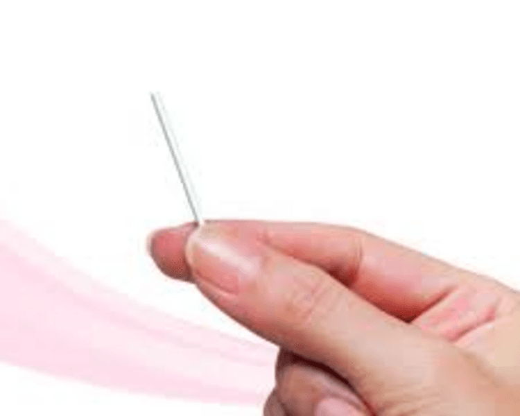 Extracción de Implanon