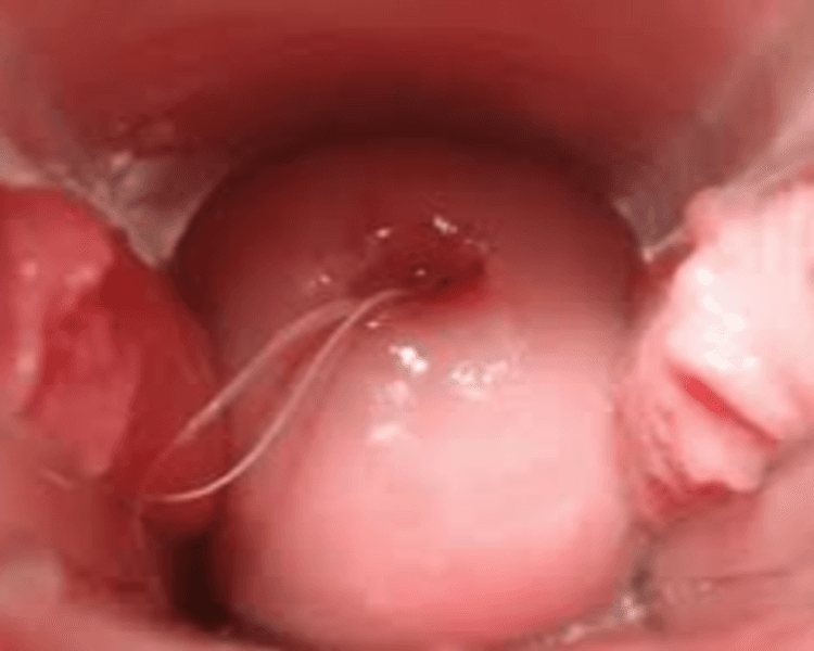 Extracción de Dispositivo Intrauterino (T de cobre u Hormonal) Incluye consulta con Matrona