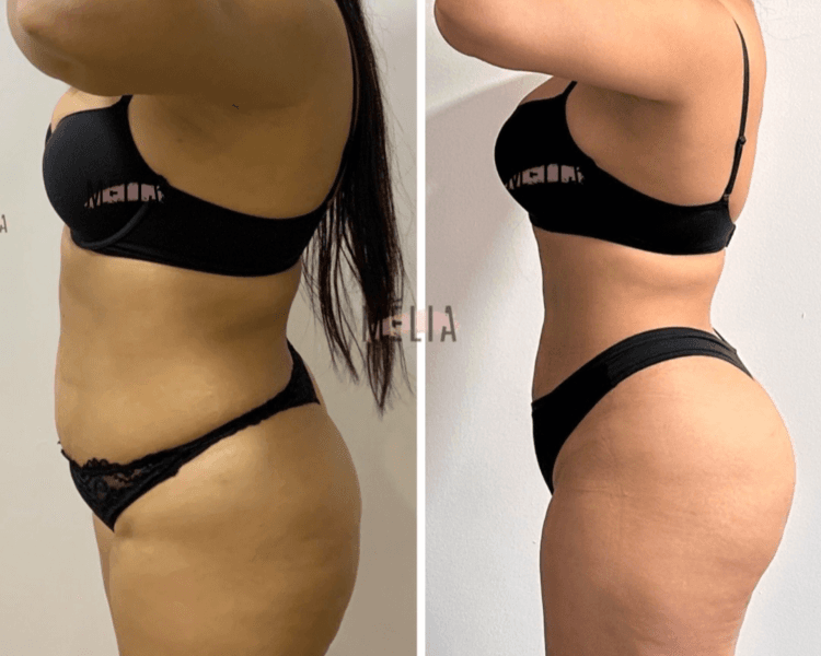 Pomp Up! Levantamiento de glúteos sesión incluye aparatología