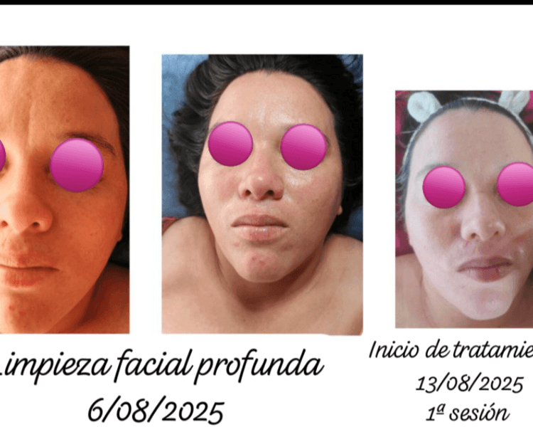 Tratamiento facial