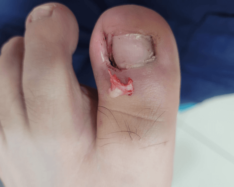 Retiro de uña encarnada