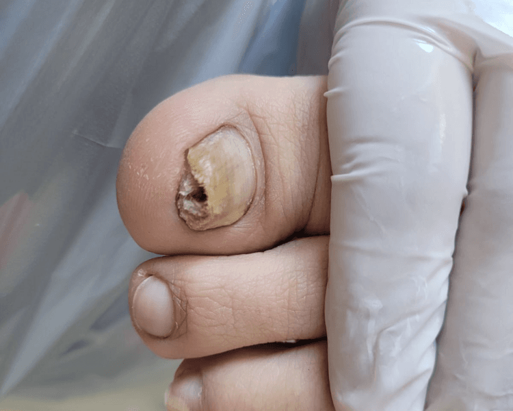 Podología básica + Tratamiento de onicomicosis (hongos en las uñas)