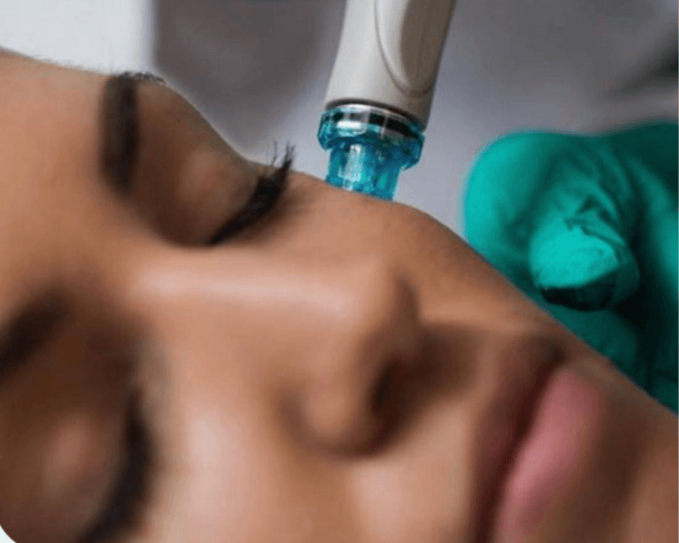 SESIÓN PRO AGE ( MICRONEEDLING )