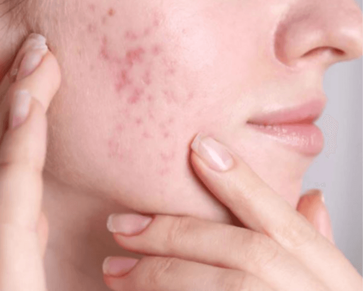 Pack Acné Peeling químico 5 sesiones