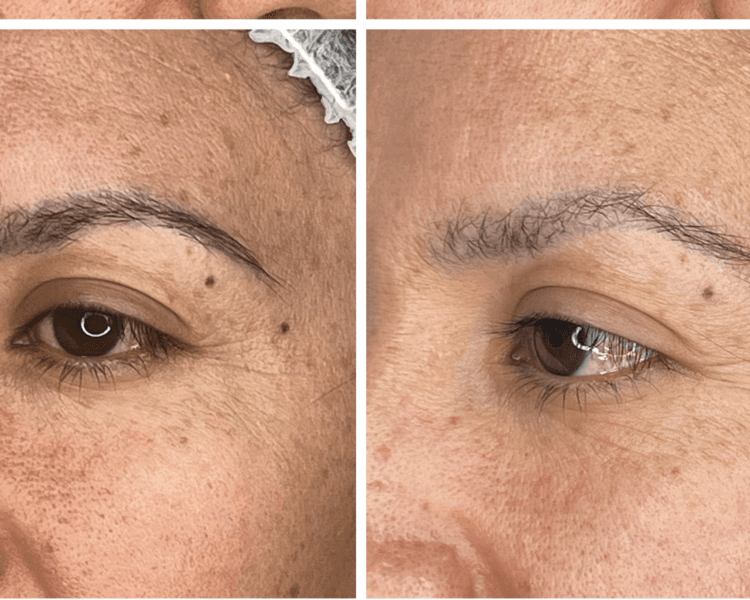 Remoción/Eliminación de Microblading Antiguo Pack 4 sesiones