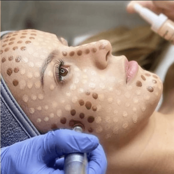 BB Glow (3 Sessions)