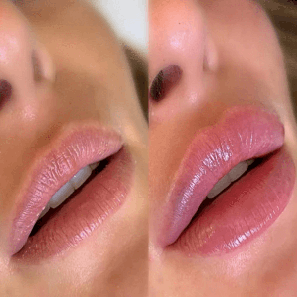 BB Lips (3 Sessions)