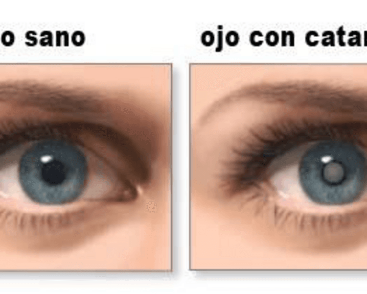 CIRUGIA DE CATARATAS FACO POR OJO TODO INCLUIDO